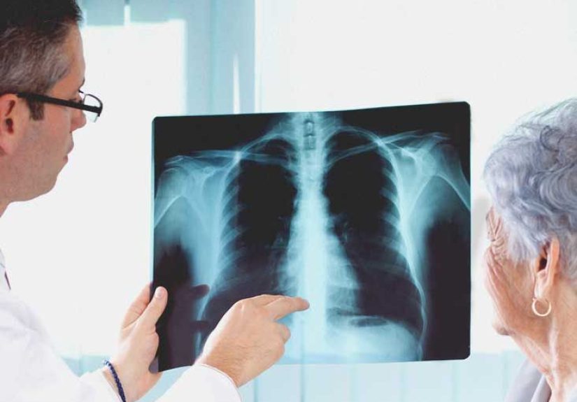 Double Pneumonia: Symptoms, Treatment, and Prognosis