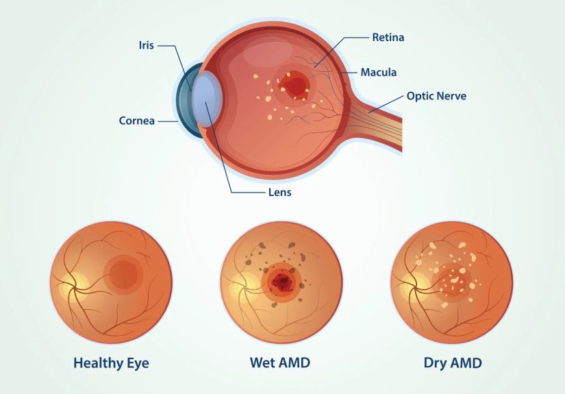 Wet Age-Related Macular (AMD) Degeneration Symptoms