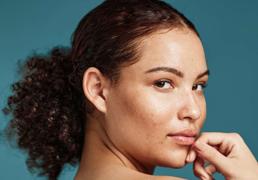 What Are Sebum Plugsand How Do You Get Rid of Them?
