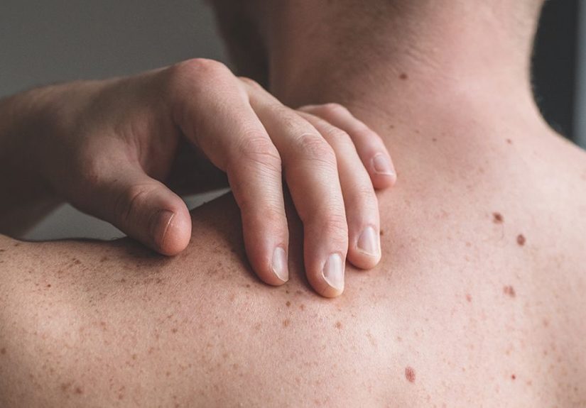 Benign Mole: Symptoms, Causes, and Treatment