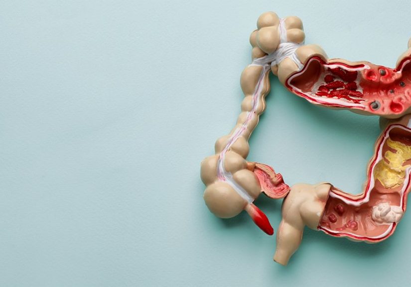 Colitis: Ulcerative, Ischemic, Microscopic and More