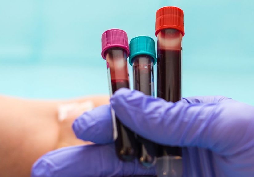 Factor VIII Assay: Purpose, Preparation, Results, and More
