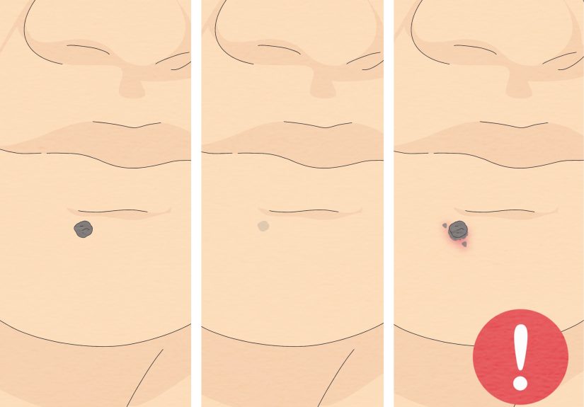 How to Remove a Mole with Iodine: 15 Steps