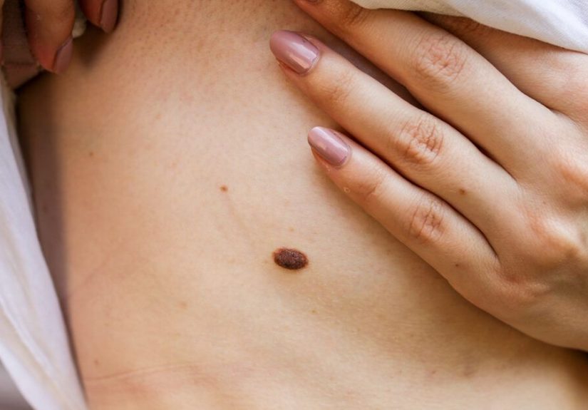 Mole Vs. Skin Tag: Understanding the Difference