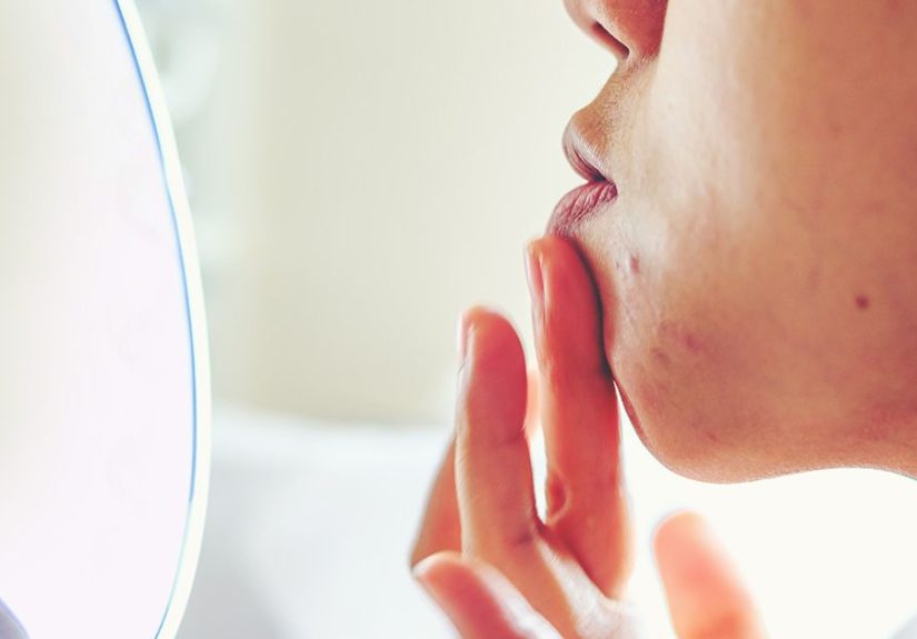 Sebum Plugs: Causes, Treatments, and More