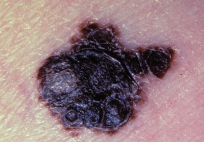 Symptoms and Pictures of Stage 4 Melanoma