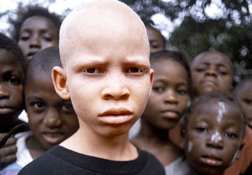 10 Tragic Facts About Albino Hunting In Africa