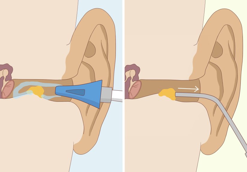 3 Easy Ways to Prevent Earwax Buildup