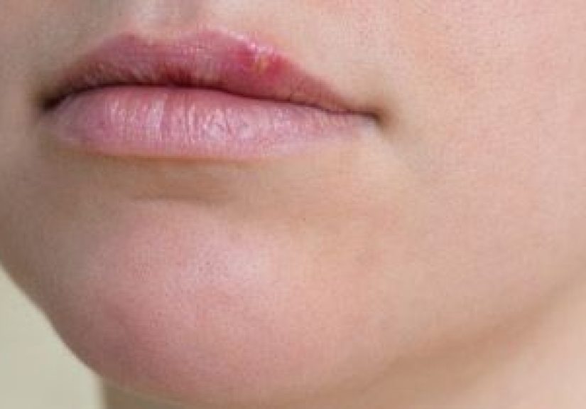 Bumps on Lips: Causes, Treatments, and More