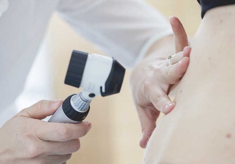 Calciphylaxis: Pictures, Definition, Symptoms, Treatment, and Outlook