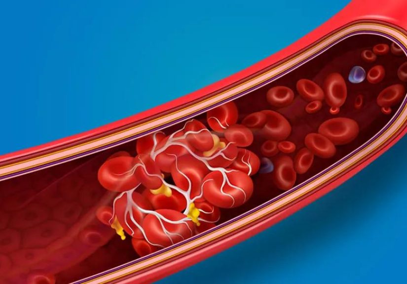 COVID-19 and Blood Clots: What To Know