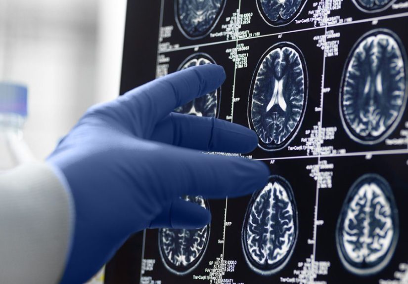 Dementia: Neurovascular, Metabolic Changes May Predict Progression
