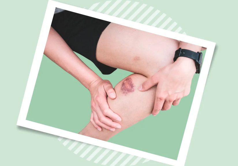 Guide to Bruised Legs After Exercise: Causes and Remedies