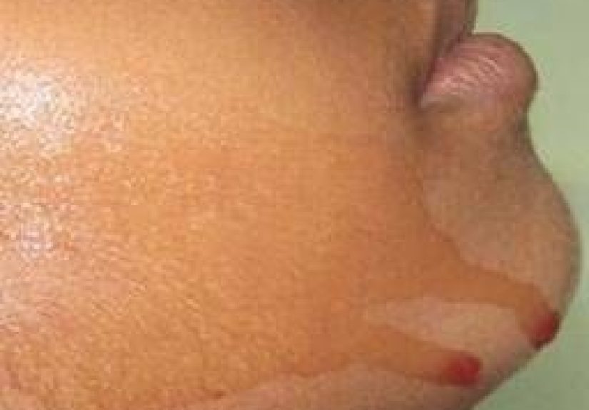 Hematidrosis (sweating blood): Causes and treatments