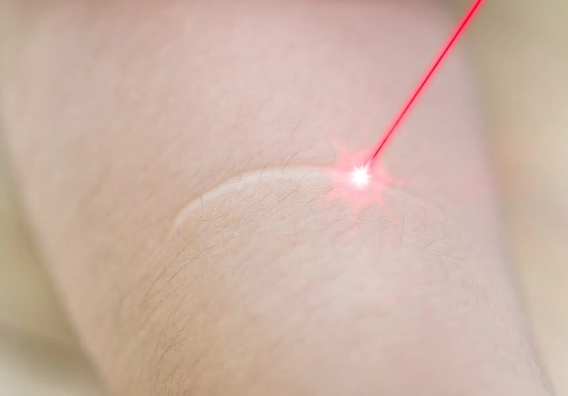 How to Make Scars Less Visible