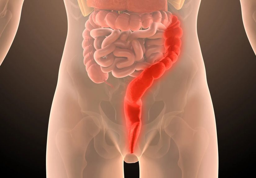Playing Through the Pain of Ulcerative Colitis