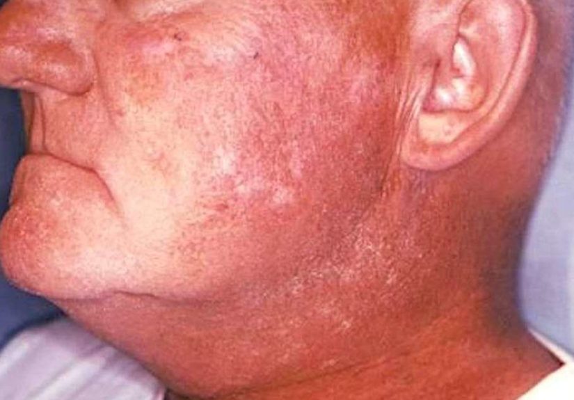 Radiation dermatitis: Symptoms, treatment, and prevention