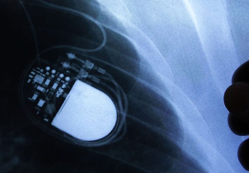 What Are Some Tips for Living With a Pacemaker?