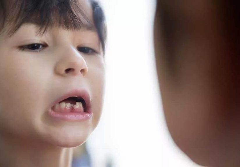 What to Do If Your Kid’s Tooth Is Knocked Loose