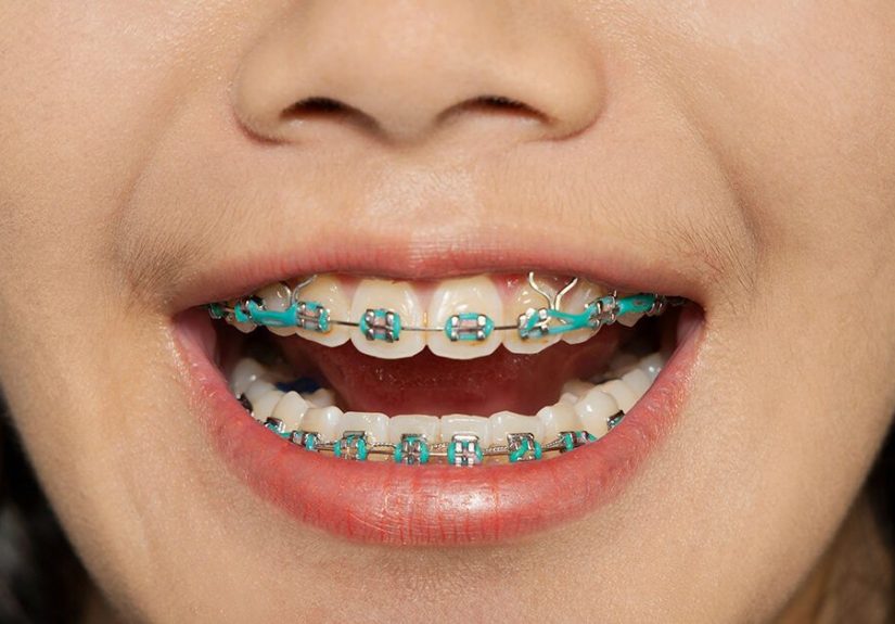 Braces with Rubber Bands: Purpose and How Long They Stay On
