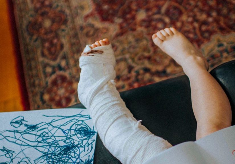 Broken Leg: Symptoms, Treatment, and Recovery Time