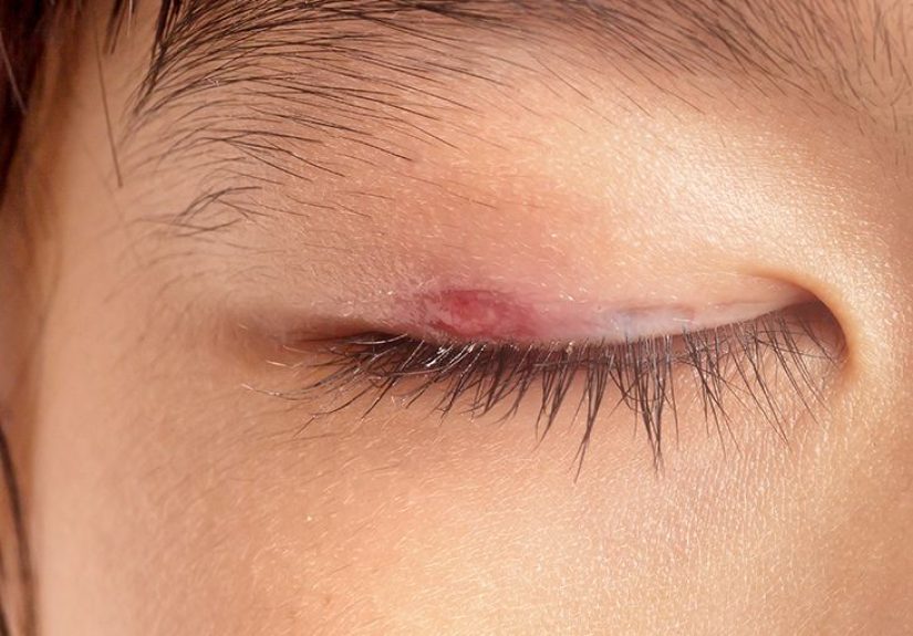 Gritty eyes: Causes, symptoms, treatments, and more