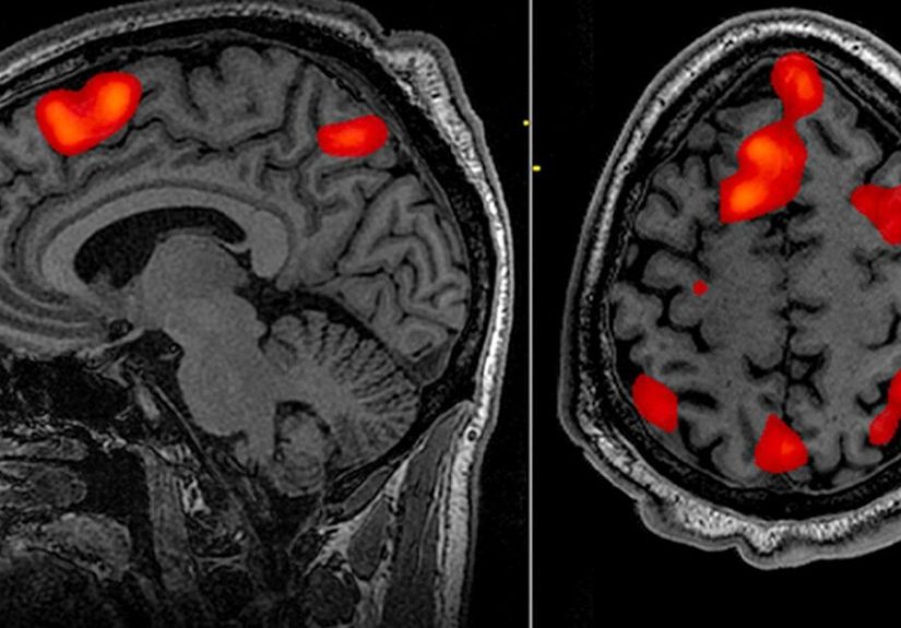 What Is fMRI? Uses, How It Works, Duration, and What to Expect