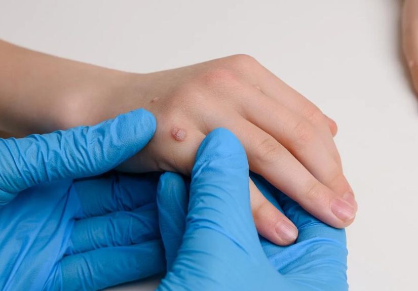 Why Do Kids Get Warts? Childhood Warts Treatment