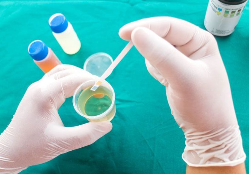 Bilirubin Urine Test: Procedure, Preparation, and Risks