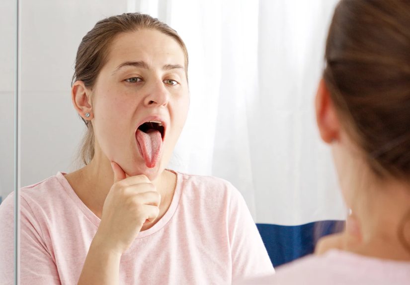 Burning Mouth Syndrome (Burning Tongue): Symptoms, Causes, Treatment