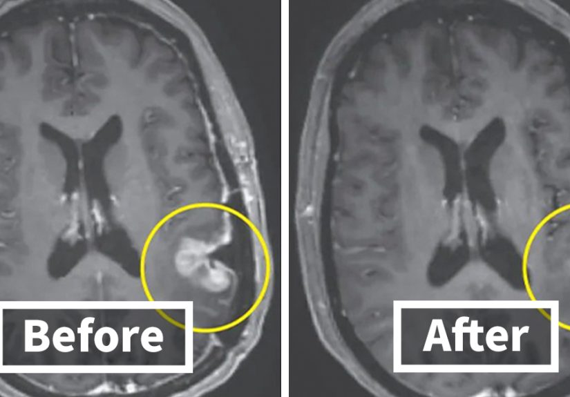 Glioblastoma Patient Sees Tumor Almost Disappear In Days Thanks To New Breakthrough
