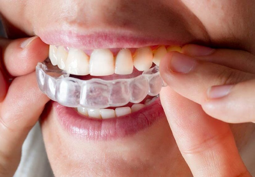 Invisalign and Fixing Overbites: How it Works, Timeline and More