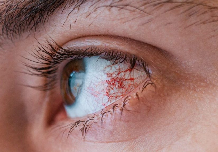 Knowing What Pink Eye Looks Like