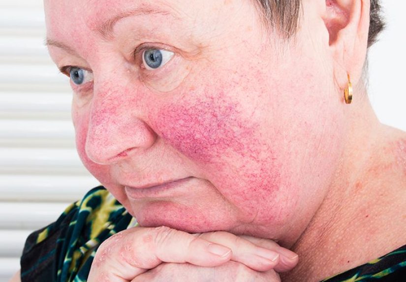 Laser Treatment for Rosacea: Results, Risks, and Cost