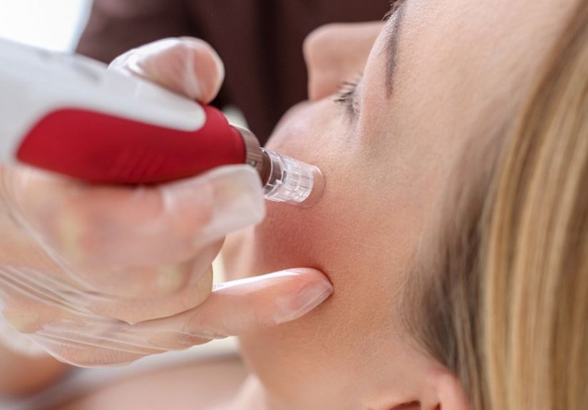 Microneedling for Acne Scars: Effectiveness, Side Effects, and Costs