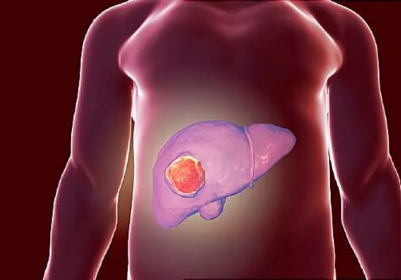 When Non-Small-Cell Lung Cancer Spreads to the Liver