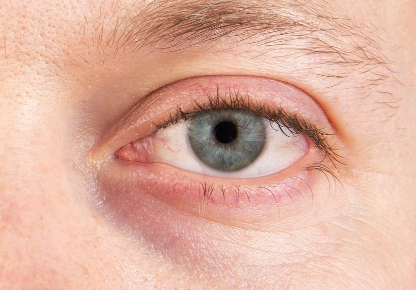 Why Is It Important to Treat Dry Eye?